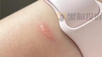 女子戴Apple Watch睡覺被燙傷起泡 蘋果客服：是過敏